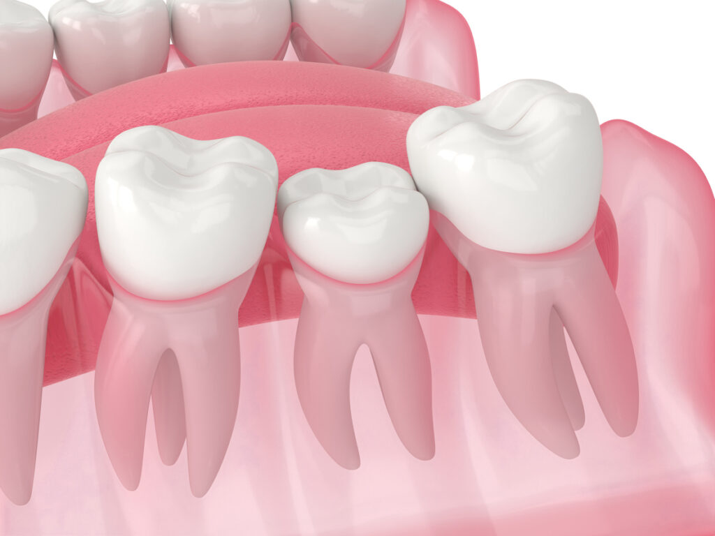 impacted tooth